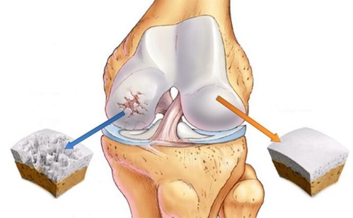cartilagem saudável e artrose do joelho