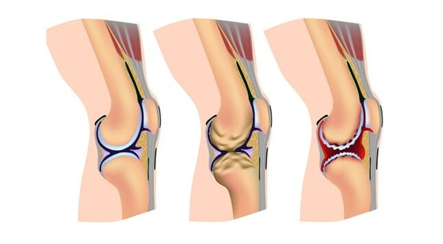 estágios de artrose da articulação do joelho