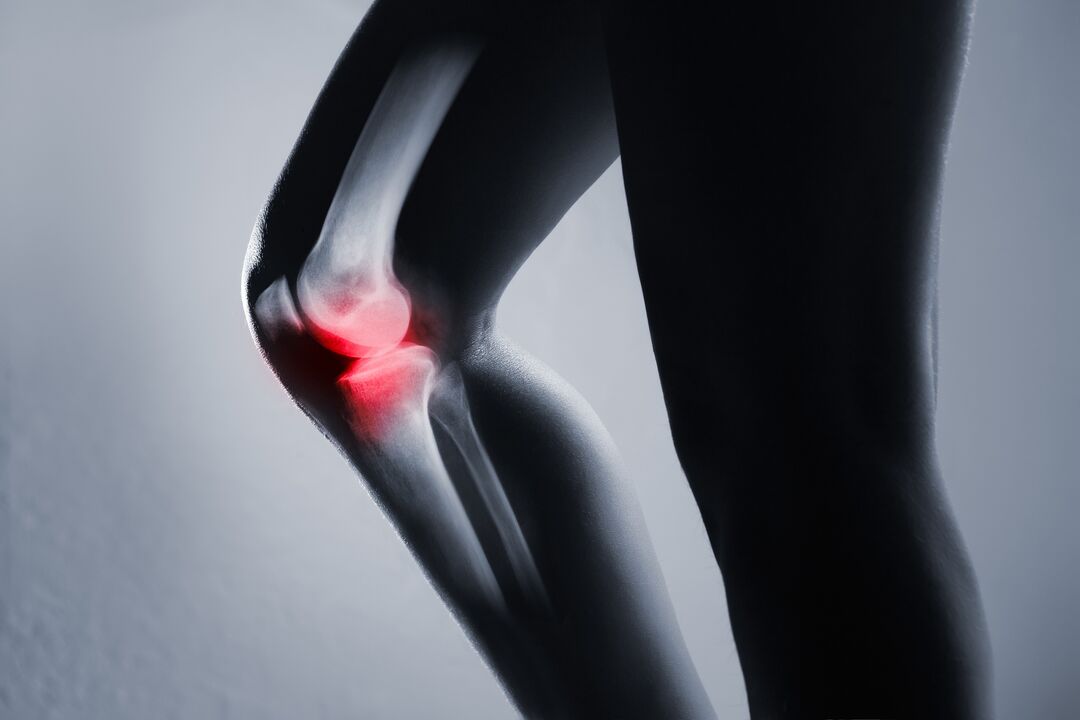 inflamação da articulação do joelho com artrose