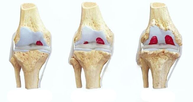 estágios da osteoartrite do joelho