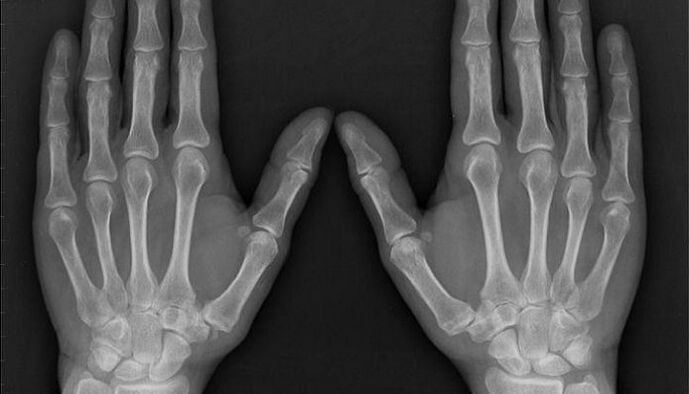 raio-x para o diagnóstico de artrite e artrose