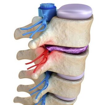 Um nervo comprimido na coluna é acompanhado por dor aguda