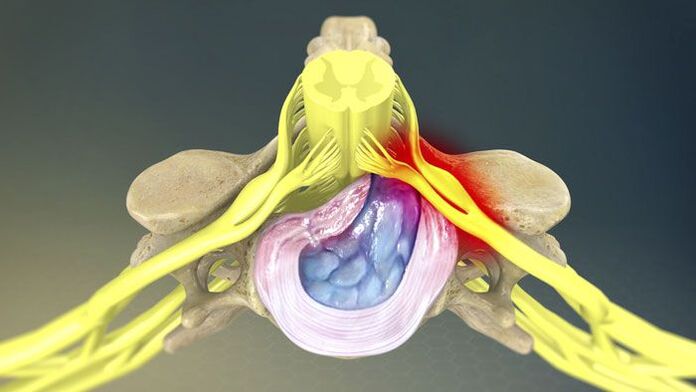 Uma das causas de dor nas costas é uma hérnia de disco. 