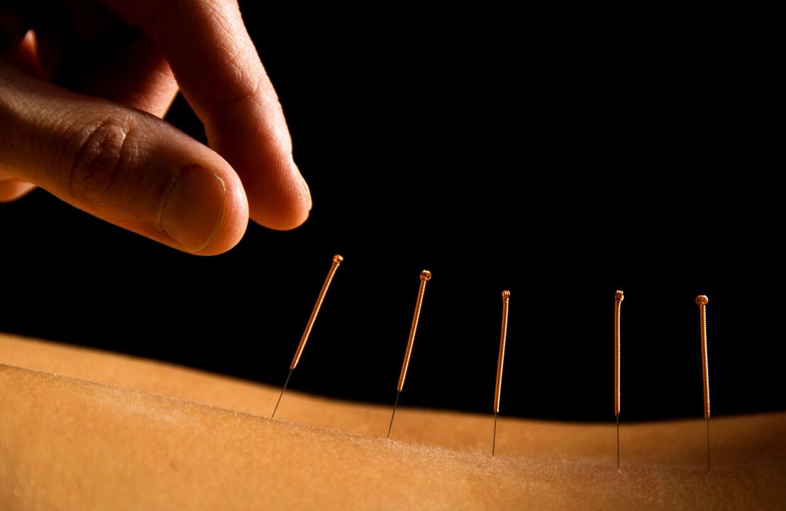 acupuntura para dor nas costas