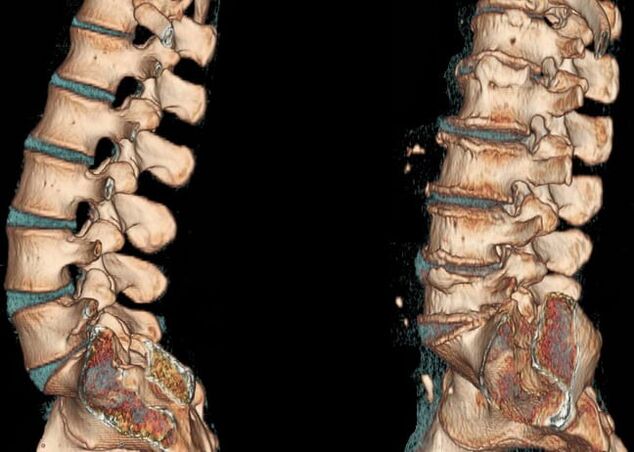 Osteocondrose da região lombar
