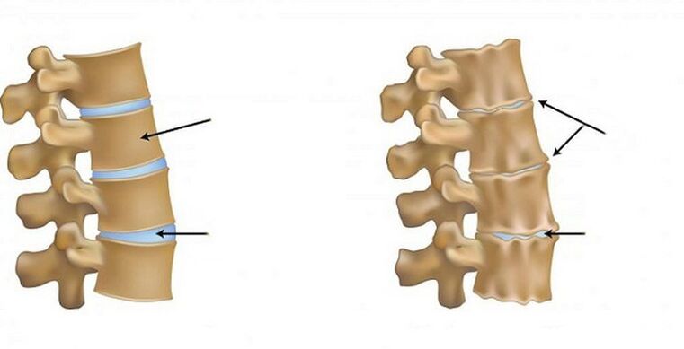 síndrome isquêmica para osteocondrose