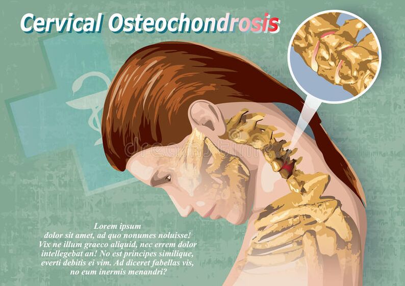 Osteocondrose cervical é uma doença de tecido da cartilagem