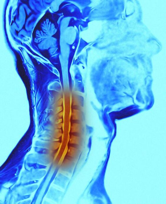 coluna cervical e osteocondrose