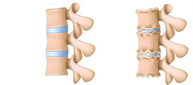 Osteocondrose por dentro